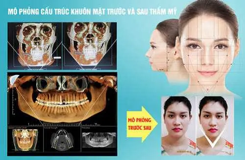 Giá gọt mặt bao nhiêu tiền