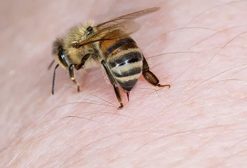 bị ong ruồi đốt có nguy hiểm không