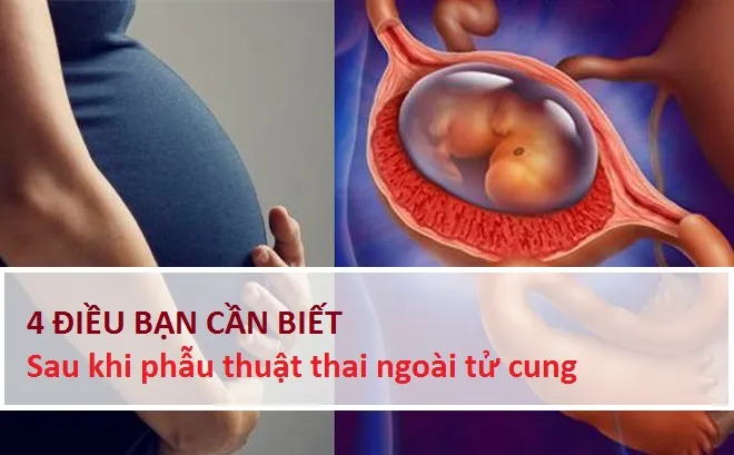 mang thai ngoài tử cung