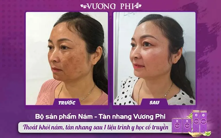 Khách hàng Hồng Vân (47 tuổi) loại bỏ nám lâu năm nhờ BSP Vương Phi